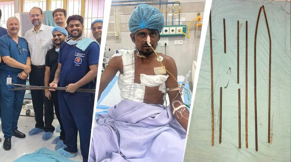 4 लोहे के सरियों के साथ अस्पताल पहुंचा मजदूर, KGMU में साढ़े आठ घंटे चली सर्जरी बनी नई जिंदगी की उम्मीद